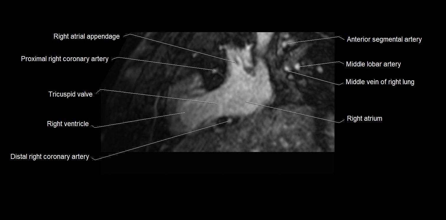 MRI heart and coronary arteries two chamber(sagittal)  anatomy image 9.webp